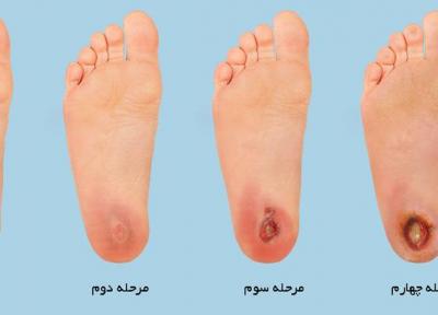 زخم دیابت و روش های درمان