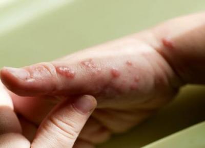 احتمال ابتلا به زونا در مبتلایان به کرونا